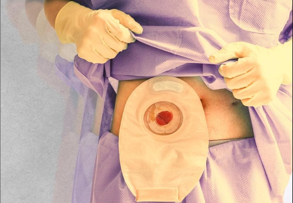 Stigma and Stoma: Time to Prescribe Support Beyond Cure